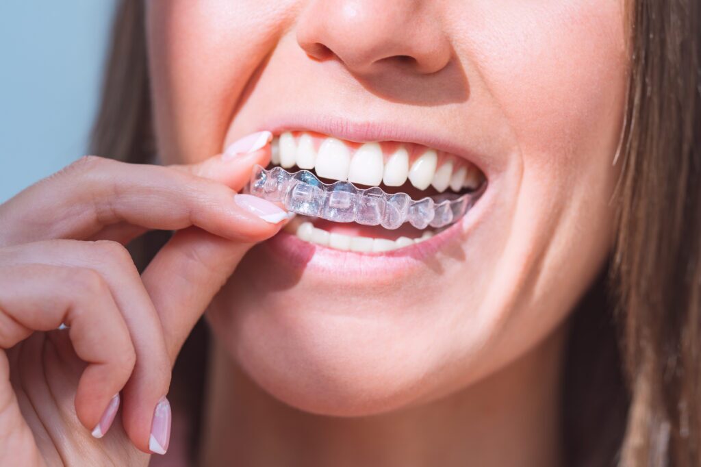Woman with perfect smile wearing invisible dental aligners for dental correction